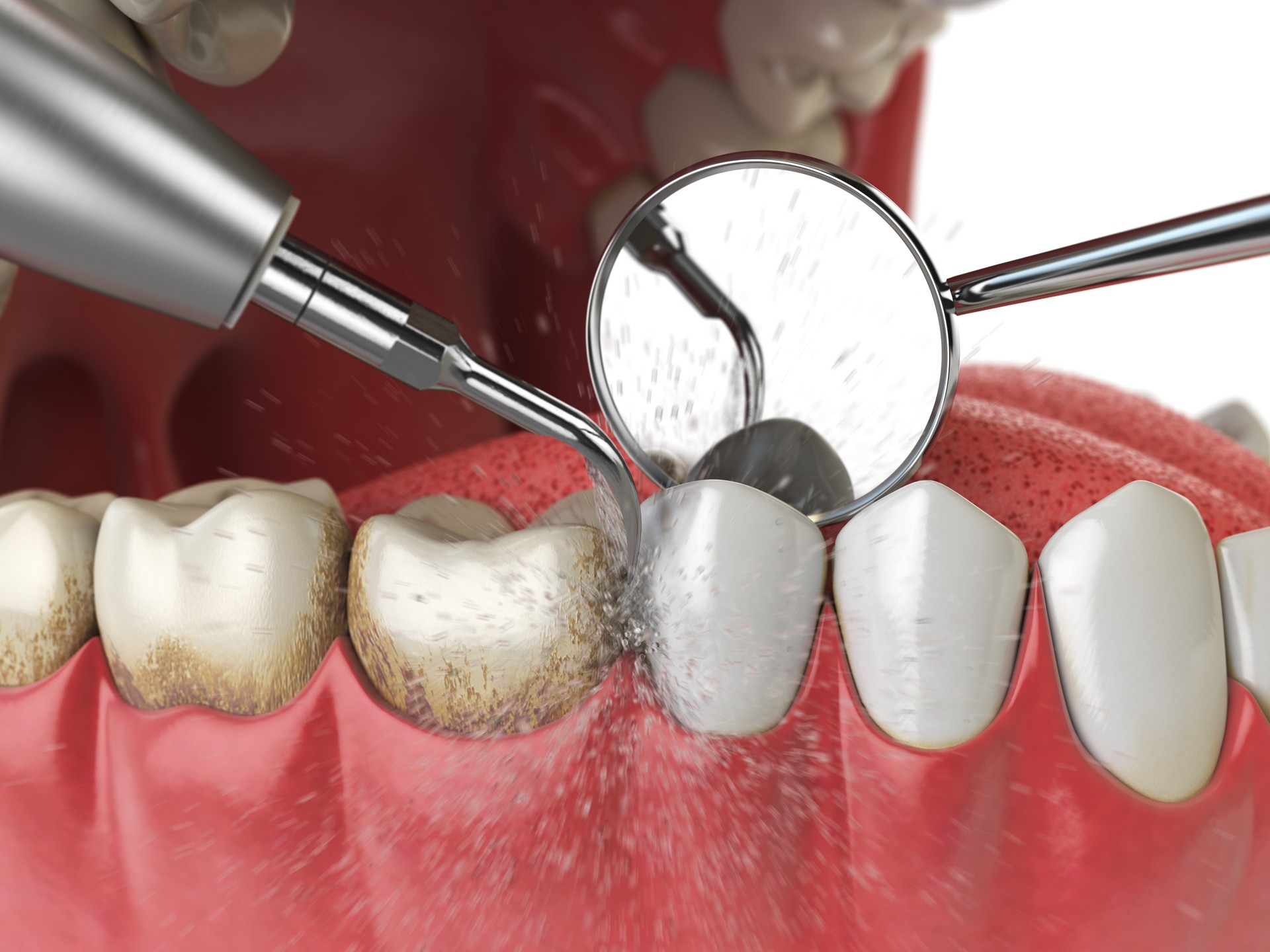 Professional teeth cleaning. Ultrasonic teeth cleaning machine delete dental calculus from human teeth.
