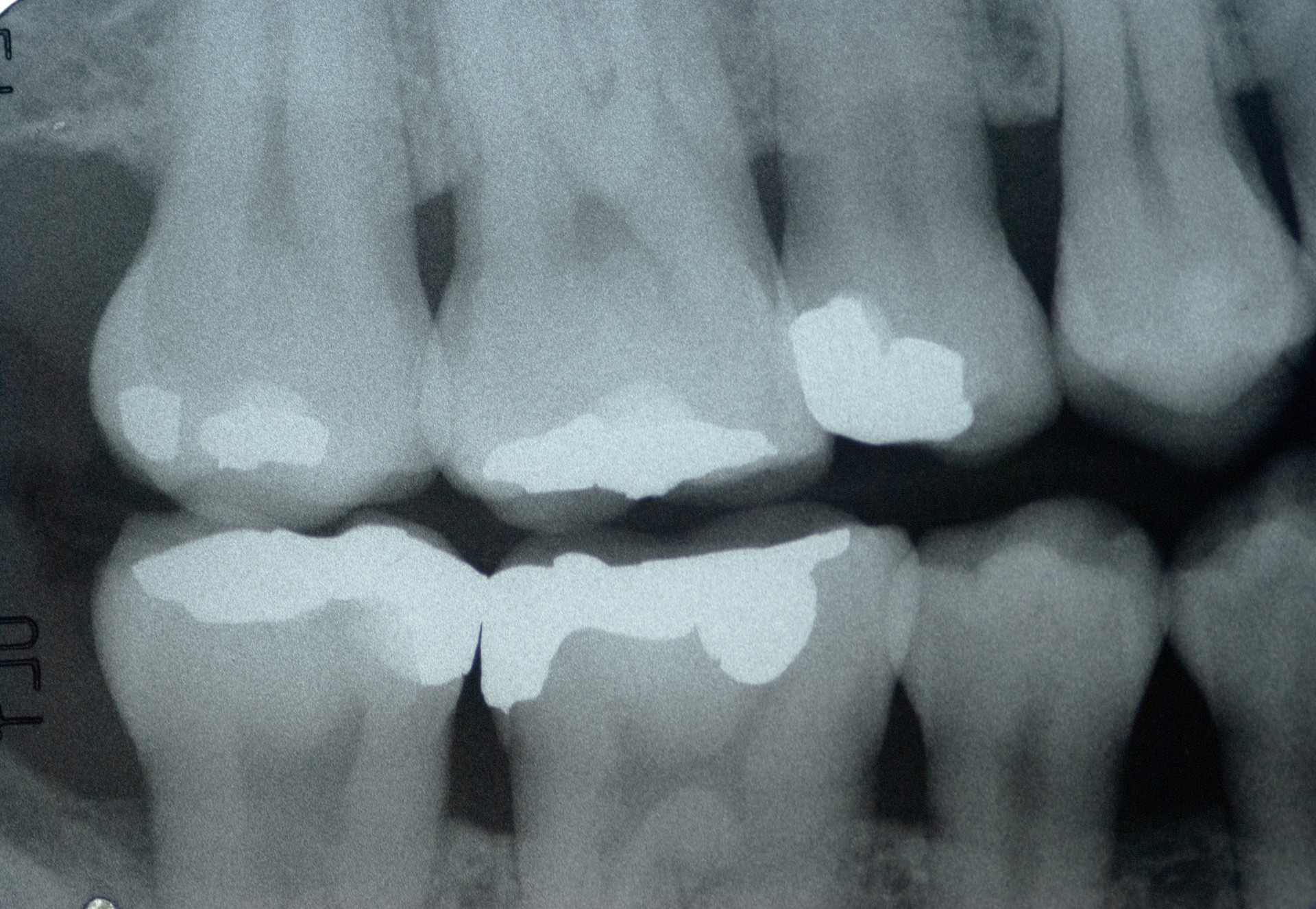 Dental x-ray  ( Bitewing technic )